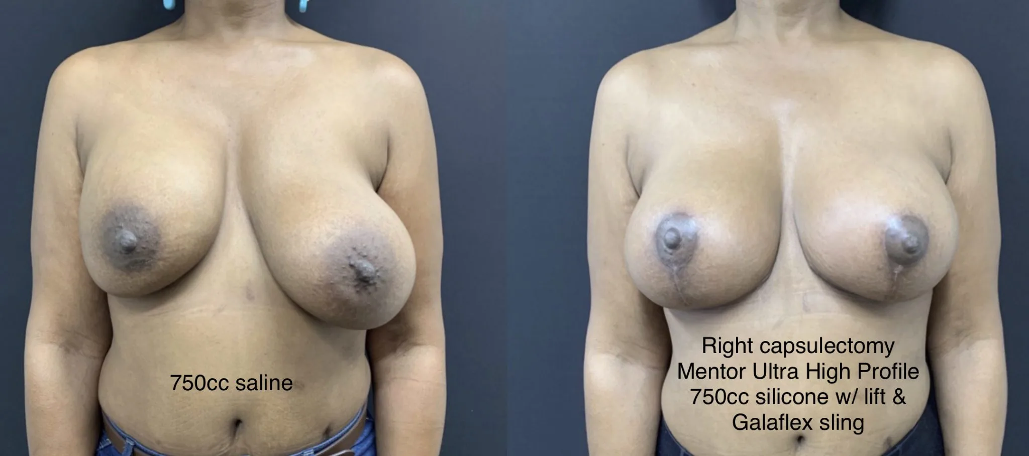 BREAST REVISION Before & After Case Number 0005
