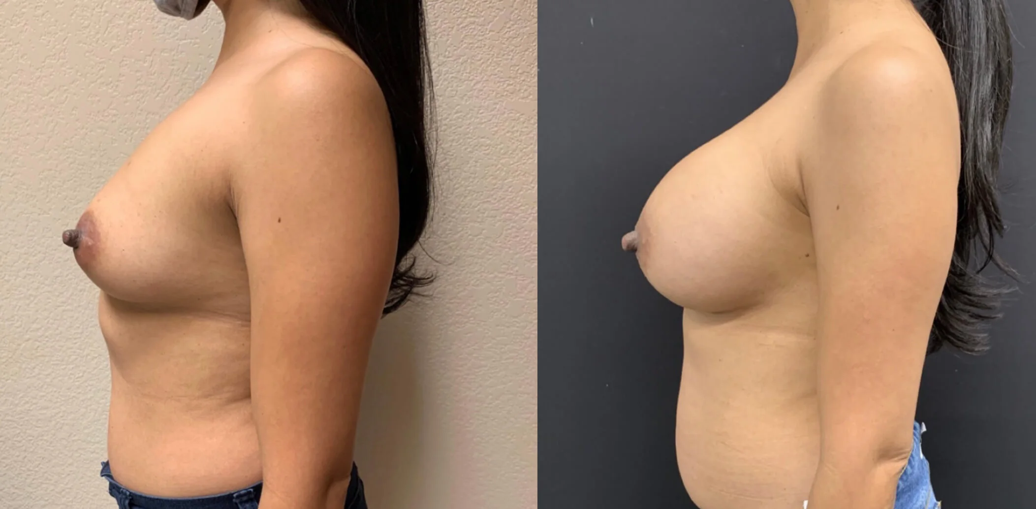 Breast Augmentation Before & After Case Number 0002