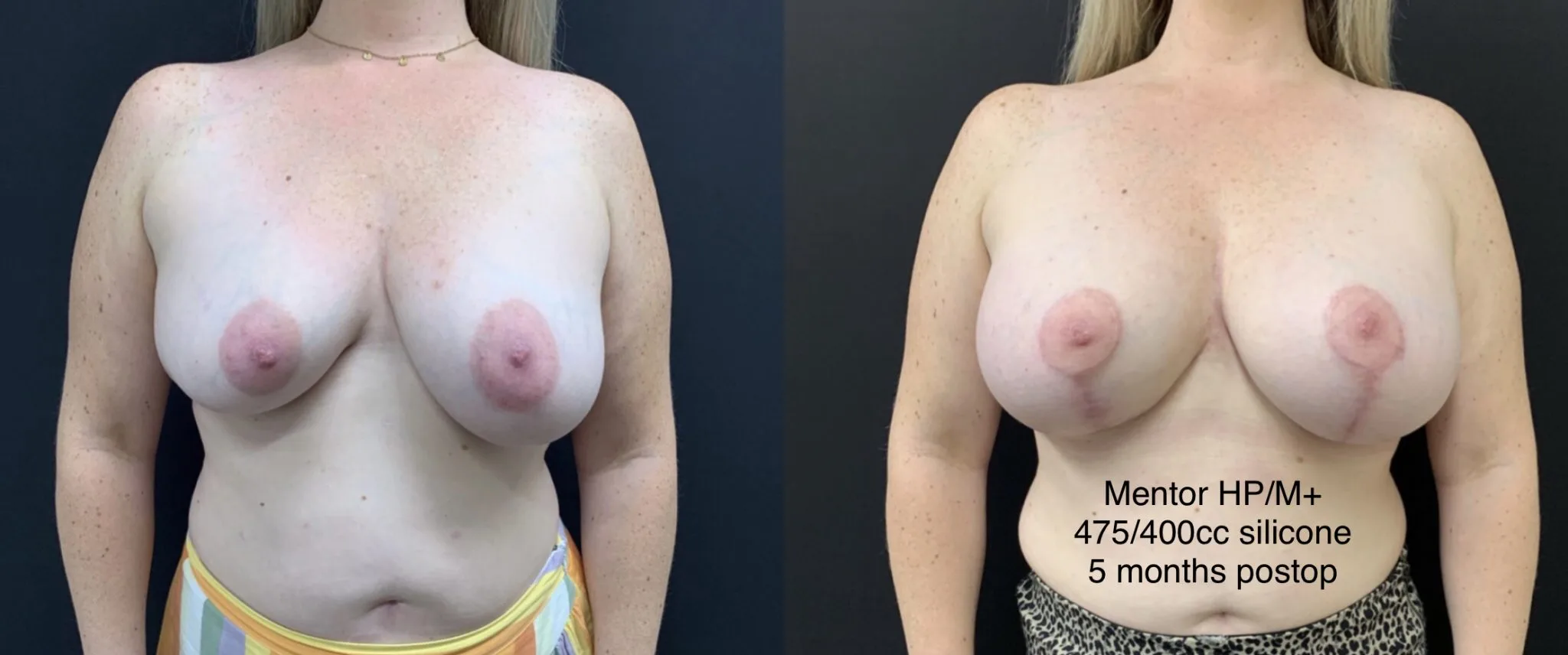CORRECTION OF BREAST SYMMETRY Before & After case 17