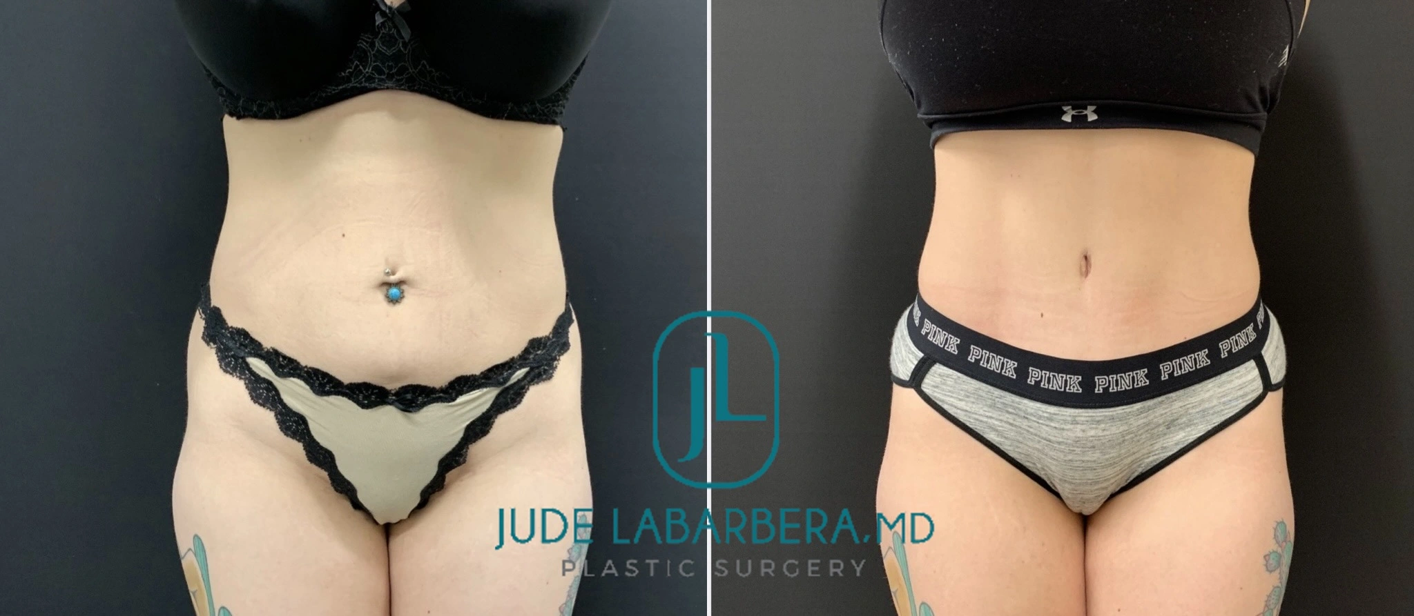 Before and after comparison of tummy tuck results showing flatter abdomen