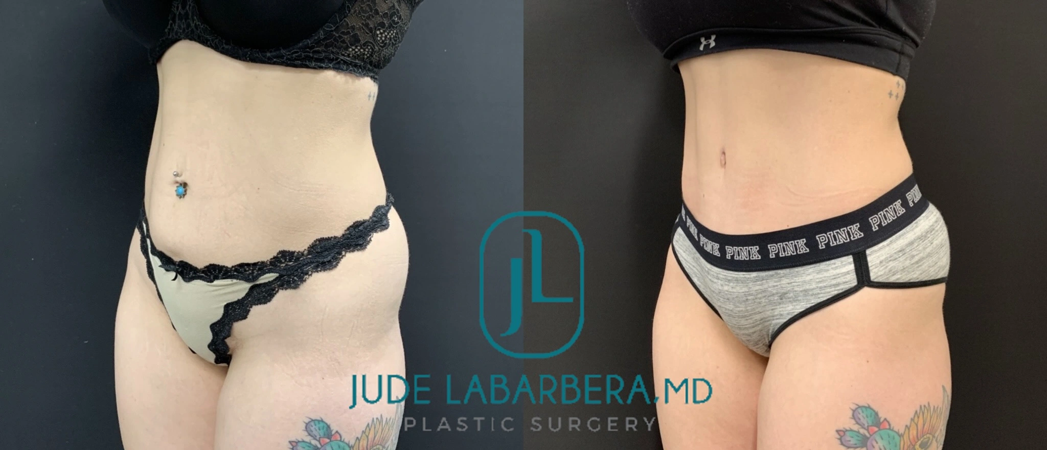Before and after comparison of liposuction results on abdomen and flanks