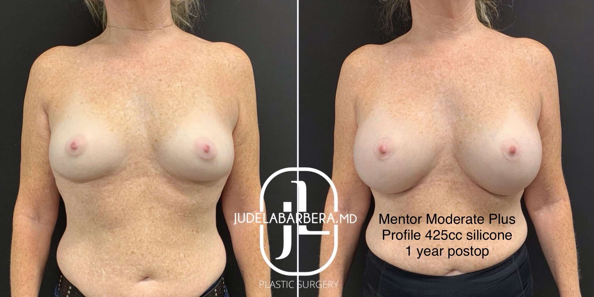 Before and after breast augmentation with Mentor Moderate Plus Profile 425cc silicone implants, 1 year postop