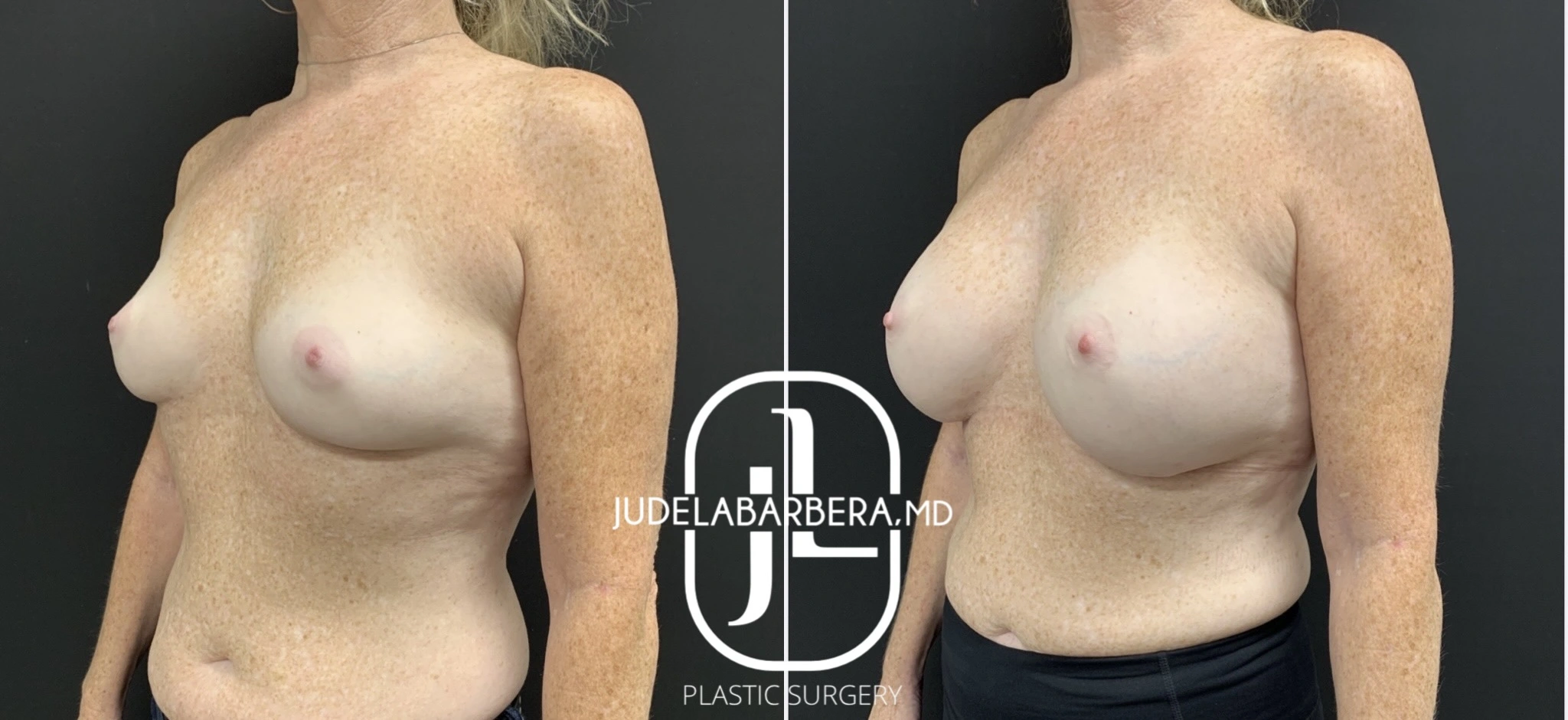 Before and after breast augmentation results by Dr. Jude Labarrera