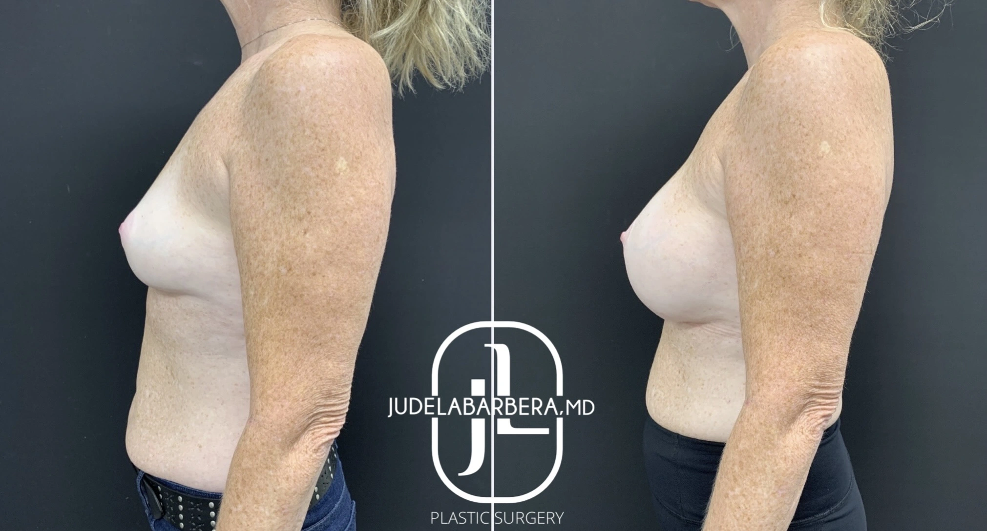 Before and after breast augmentation results by Dr. Jude Labarrera