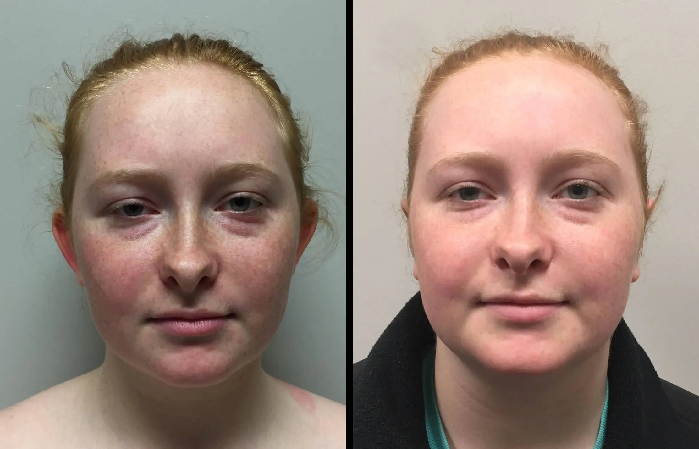 EAR SHAPING/OTOPLASTY Before & After Case Number 0001