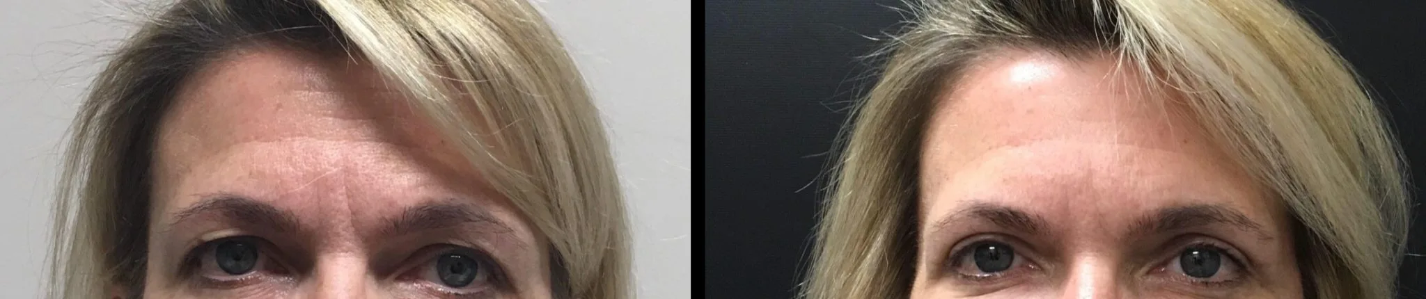 EYELID SURGERY Before & After Case Number 0001