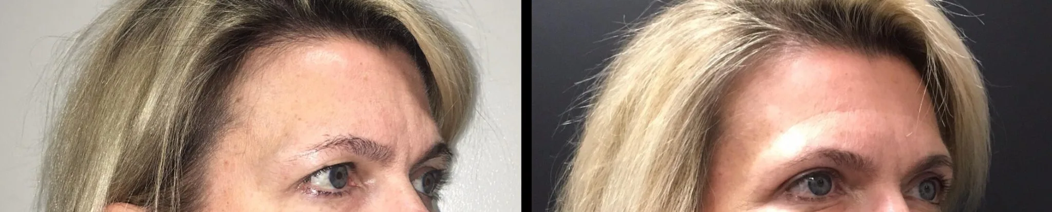 EYELID SURGERY Before & After Case Number 0001