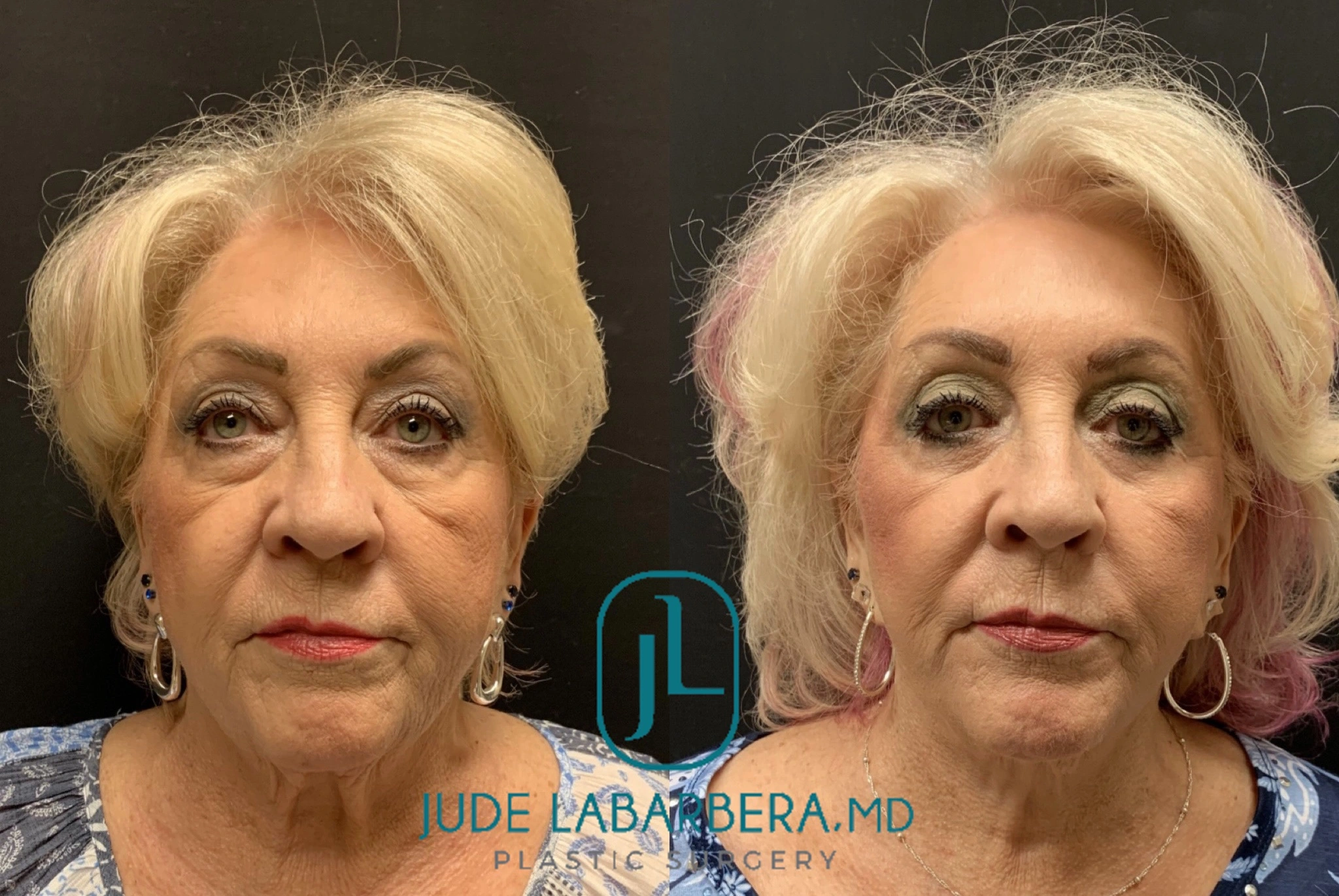 FACELIFT AND LOWER EYELID PROCEDURE Before & After Case Number 00010