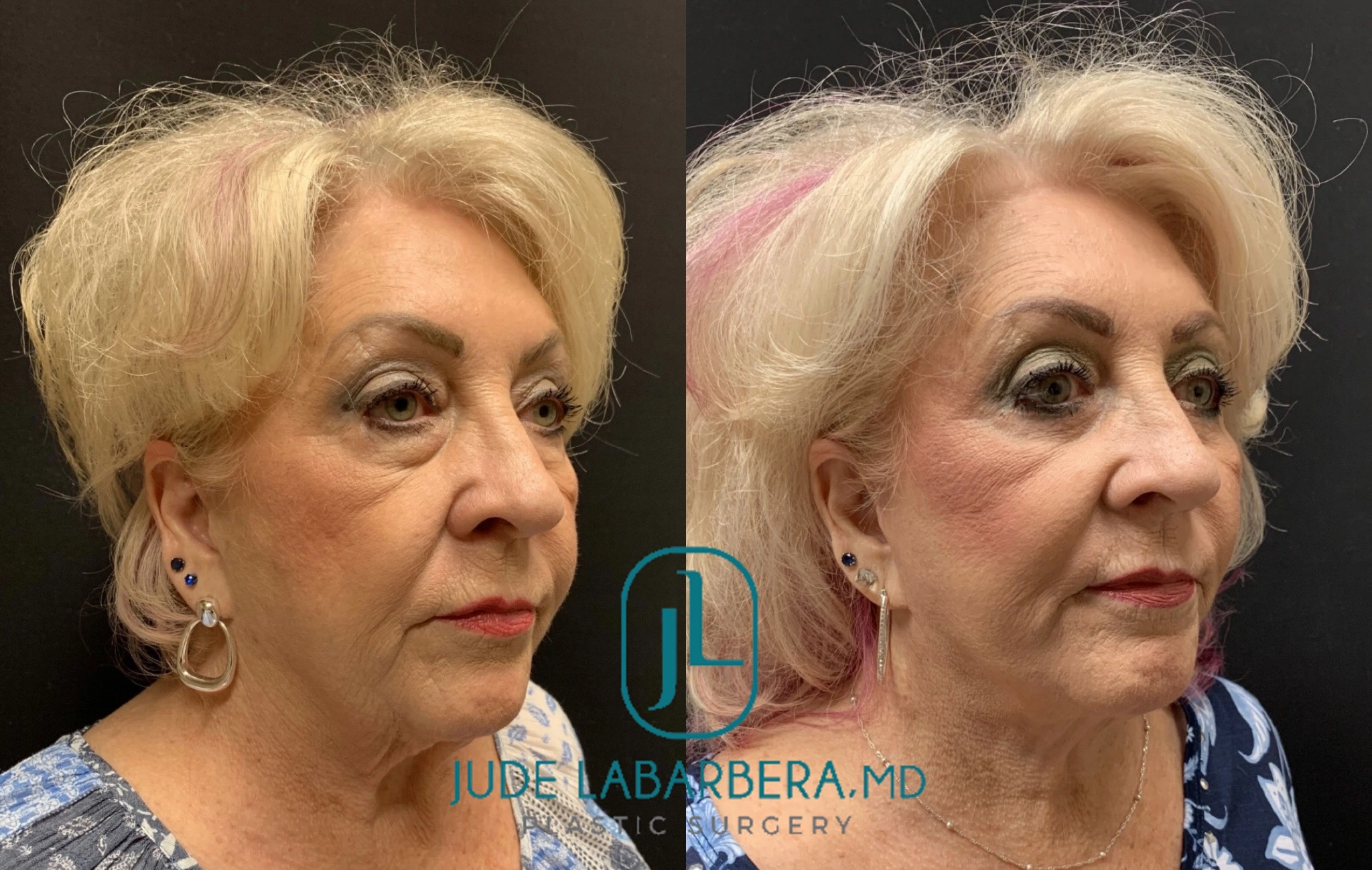 FACELIFT AND LOWER EYELID PROCEDURE Before & After Case Number 00010