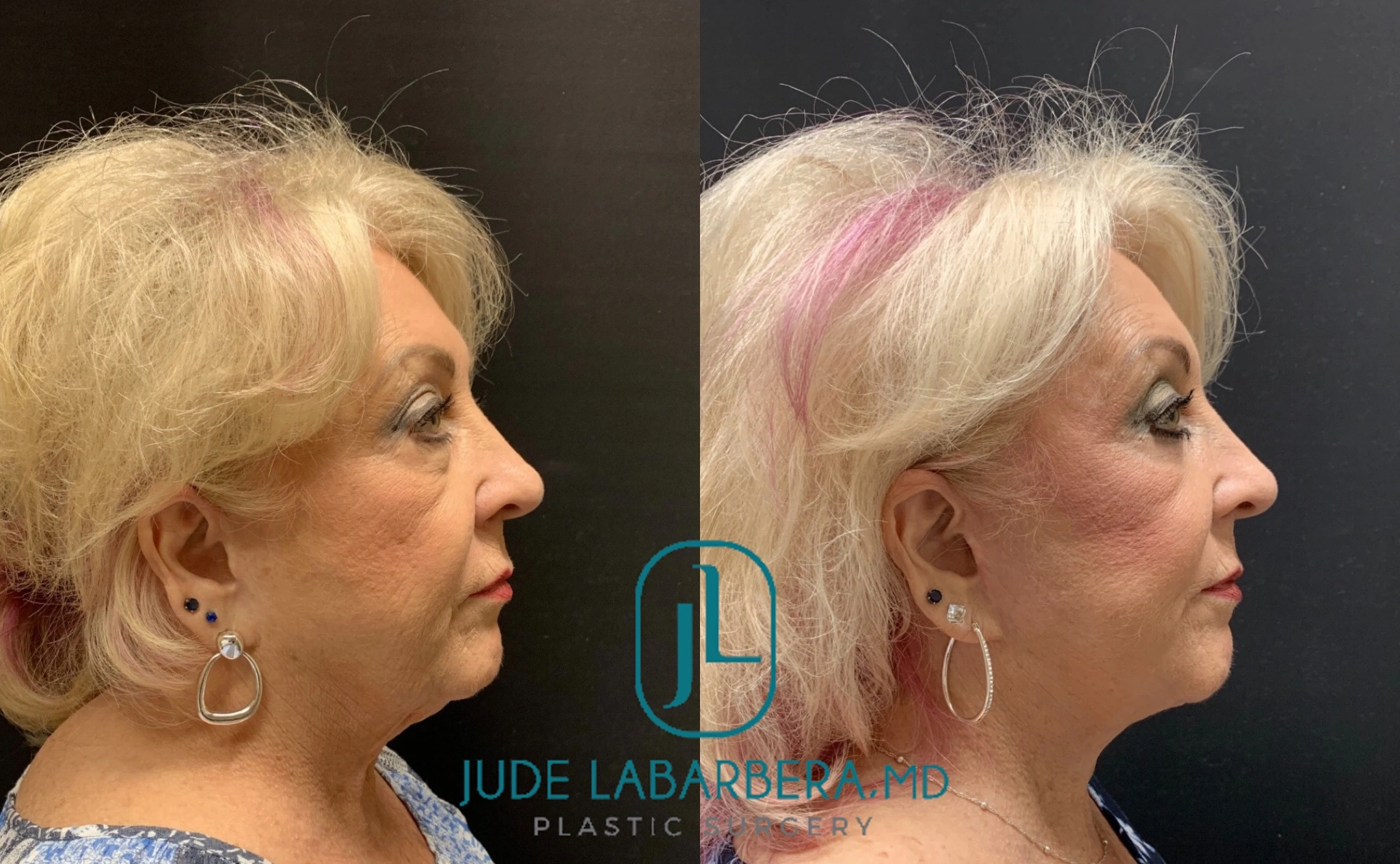 FACELIFT AND LOWER EYELID PROCEDURE Before & After Case Number 00010