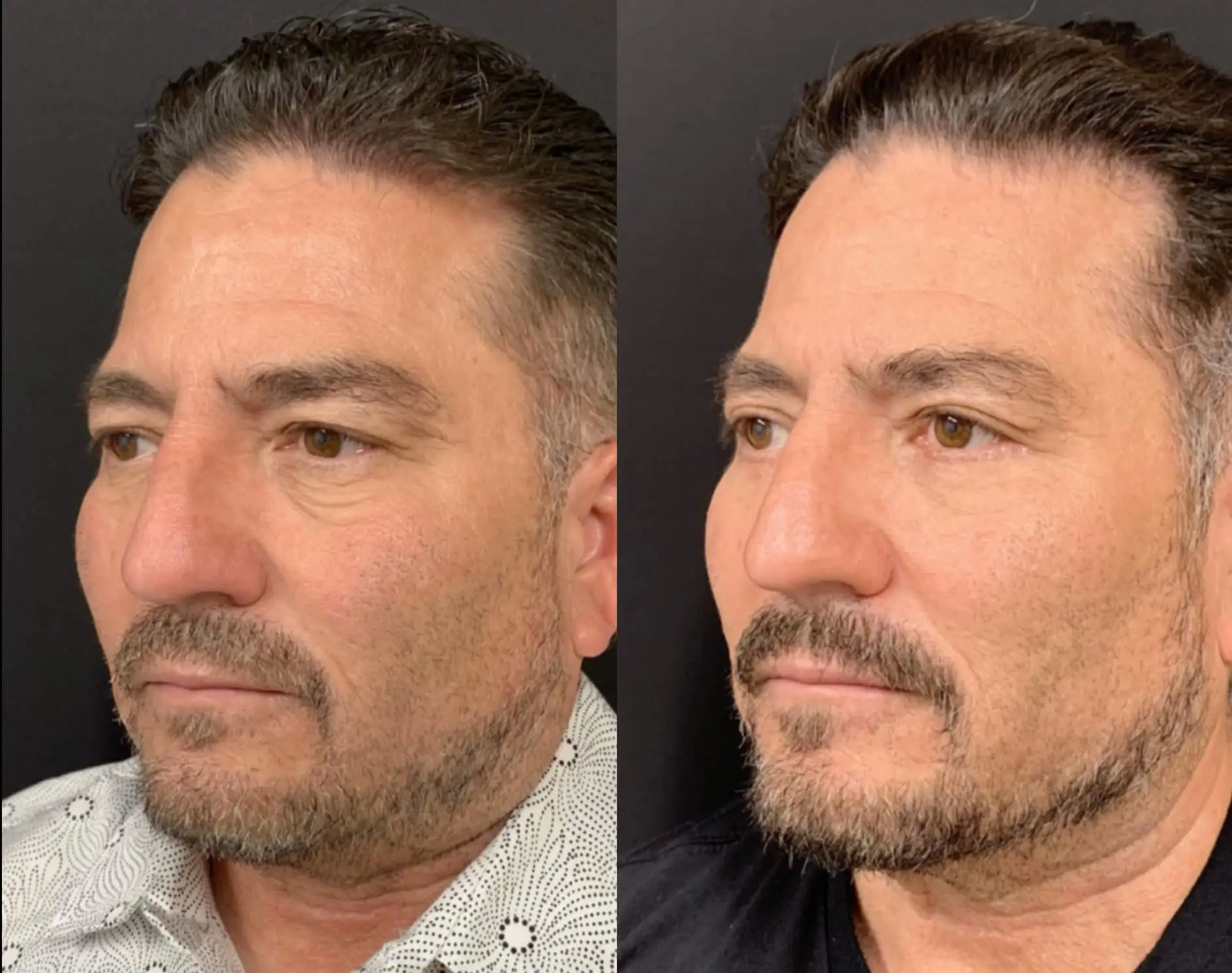 FACELIFT AND LOWER EYELID PROCEDURE Before & After Case Number 00012