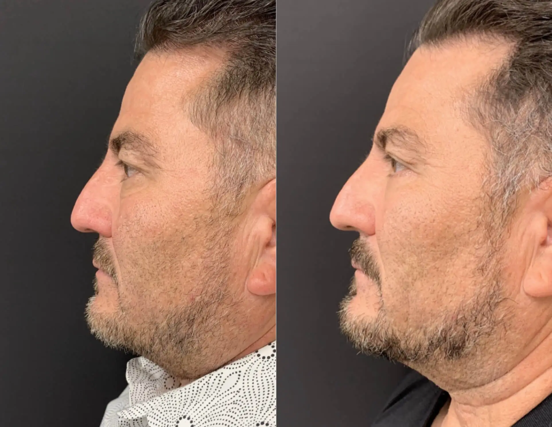 FACELIFT AND LOWER EYELID PROCEDURE Before & After Case Number 00012
