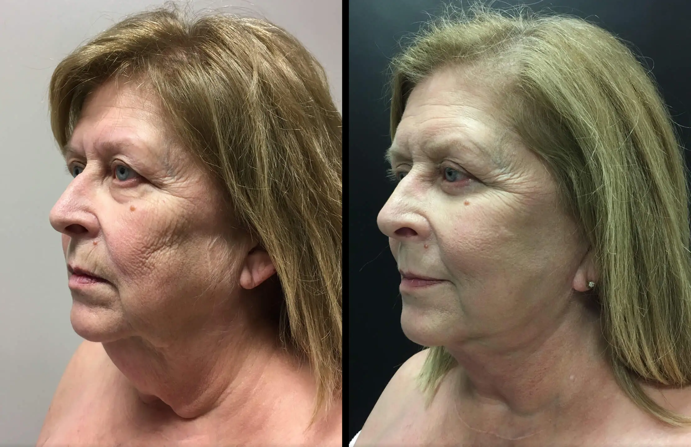 FACELIFT AND LOWER EYELID PROCEDURE Before & After Case Number 00013