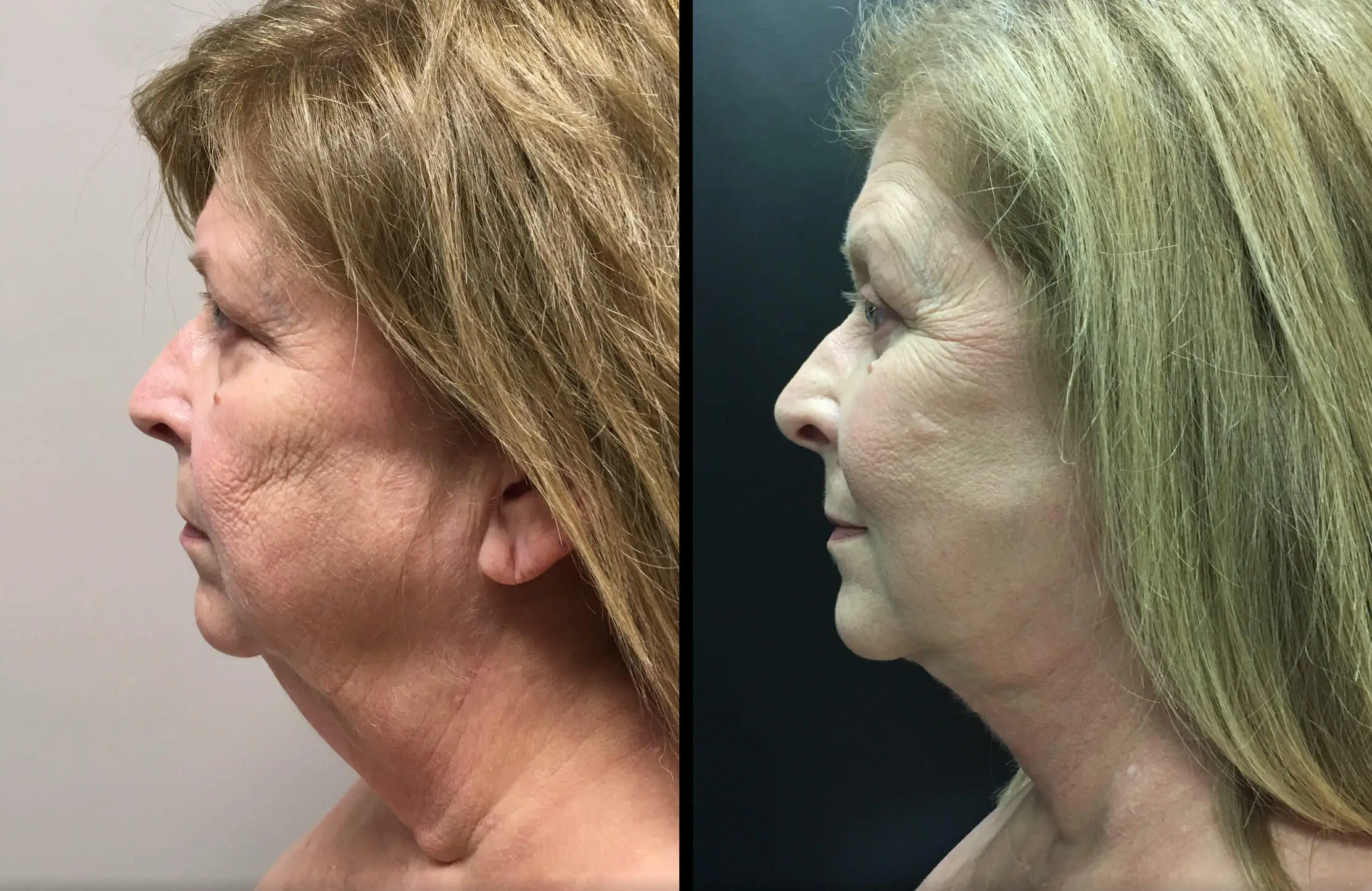 FACELIFT AND LOWER EYELID PROCEDURE Before & After Case Number 00013