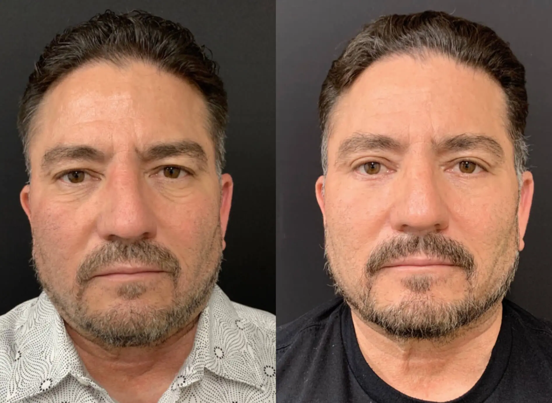 Facelift Before & After case 4