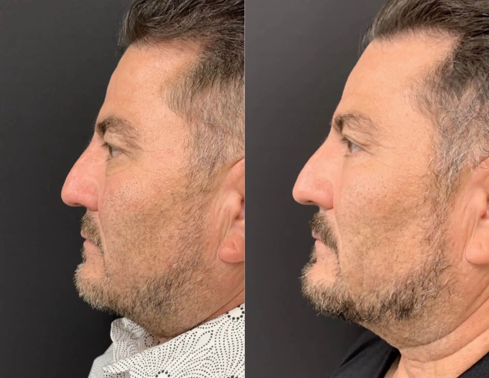 Facelift Before & After case 4