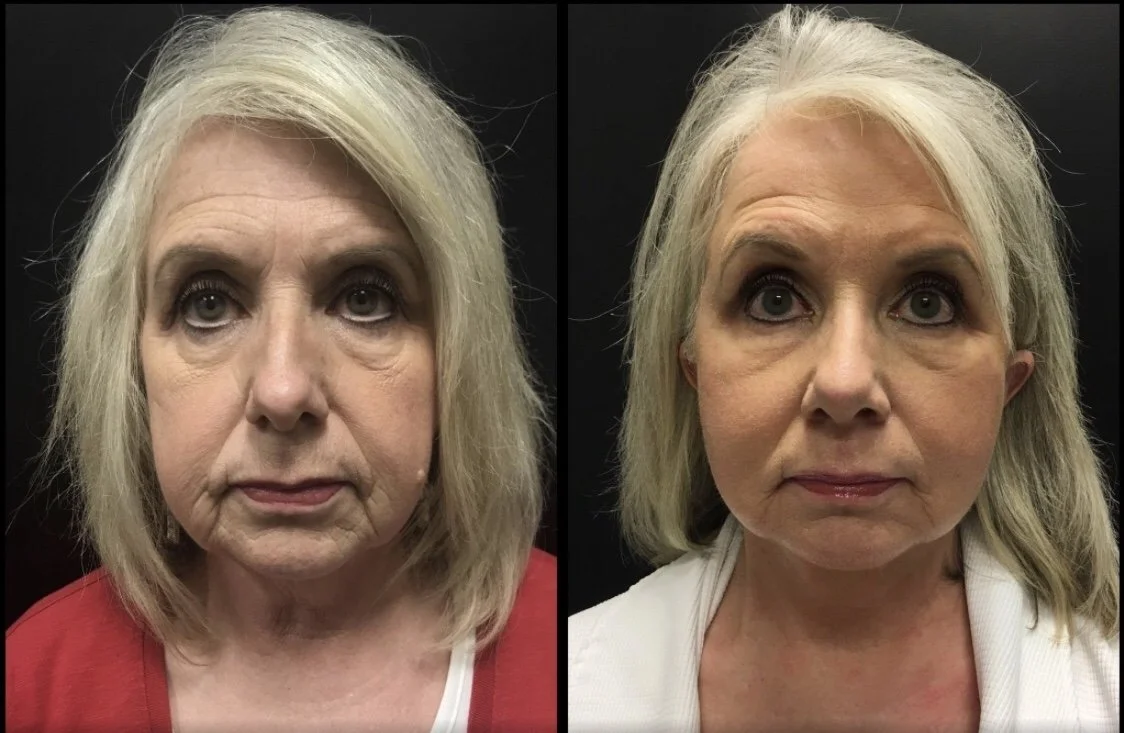 FACELIFT Before & After Case Number 0002