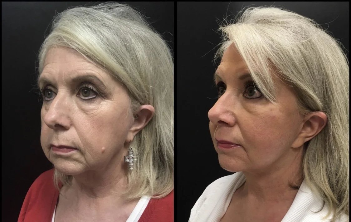 FACELIFT Before & After Case Number 0002
