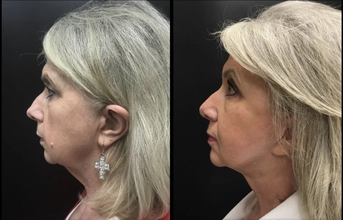 FACELIFT Before & After Case Number 0002