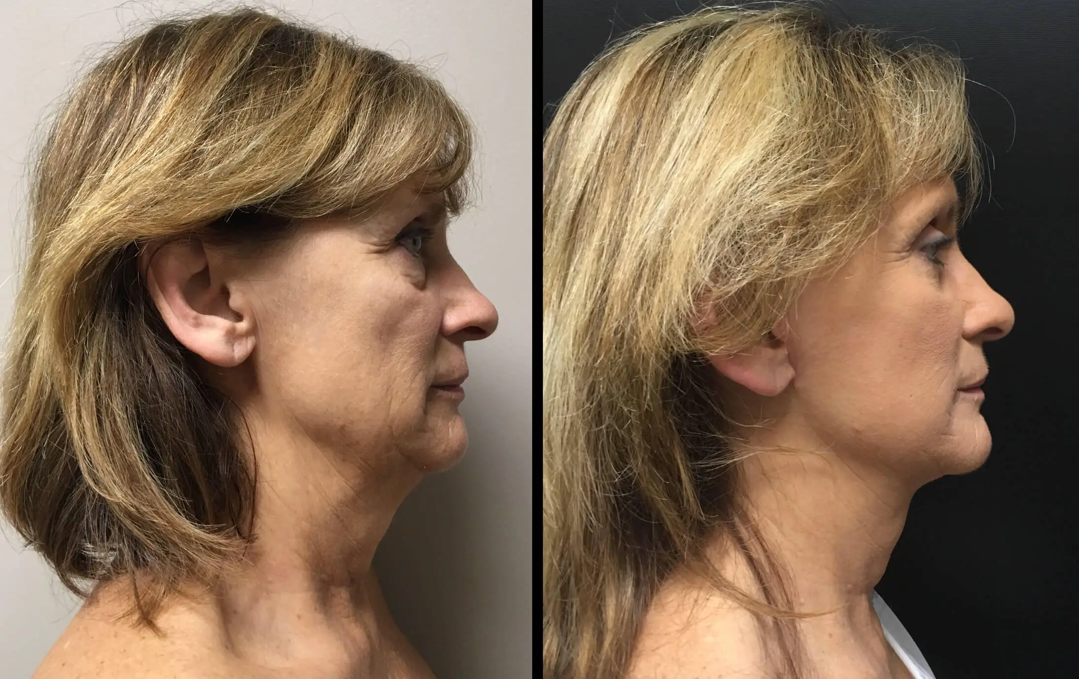 FACELIFT Before & After Case Number 0002