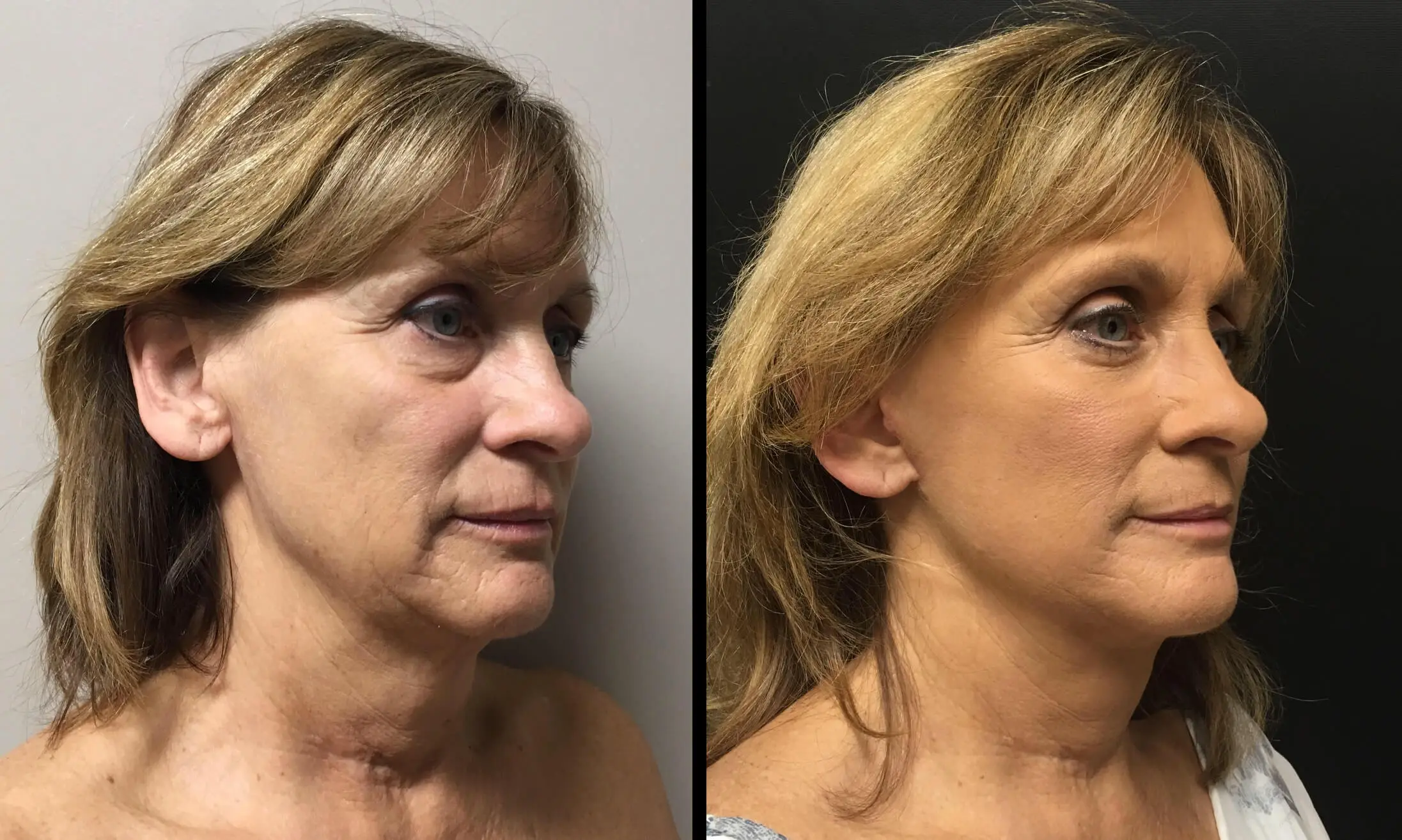 FACELIFT Before & After Case Number 0002