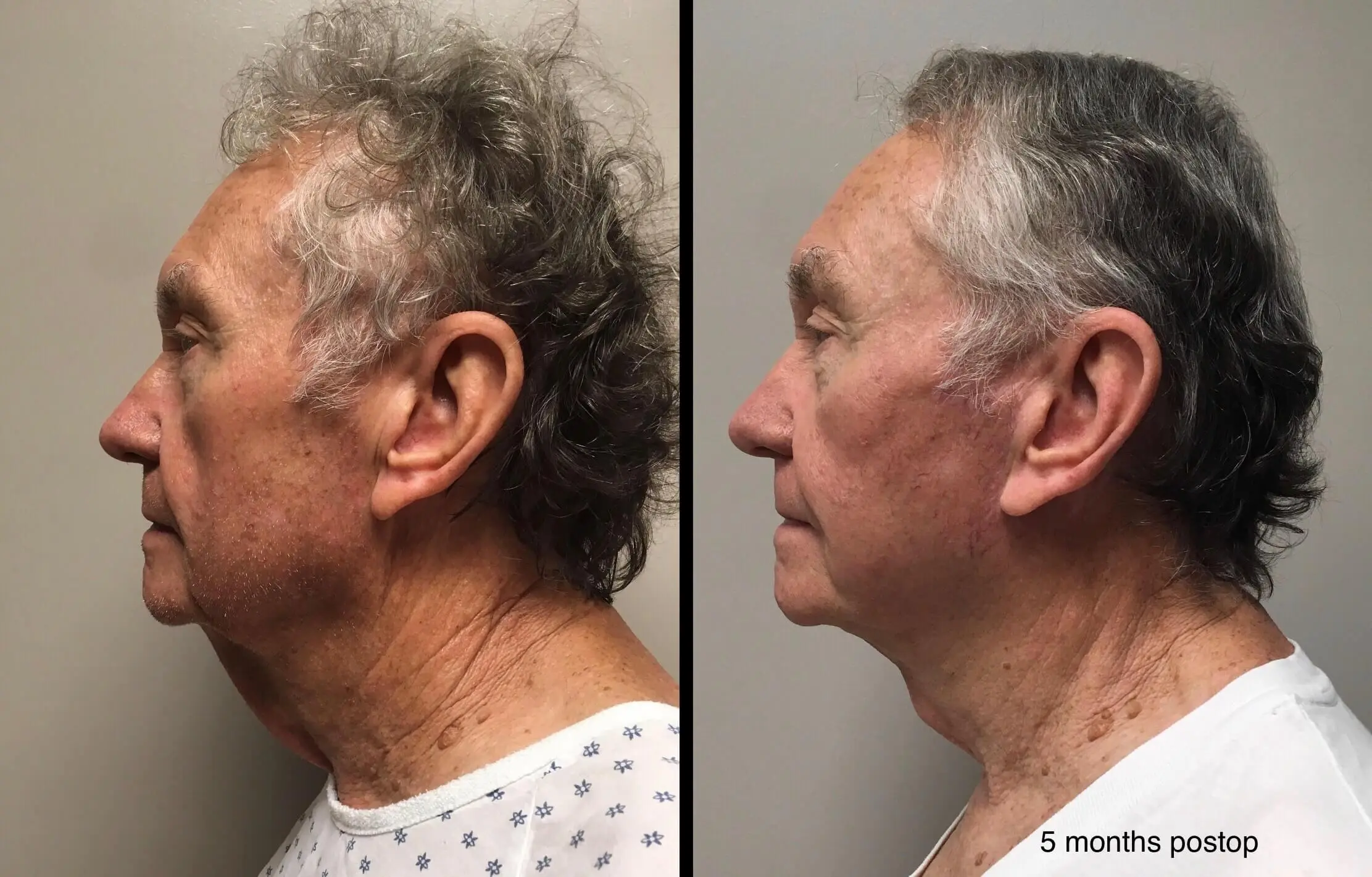 FACELIFT Before & After Case Number 0004