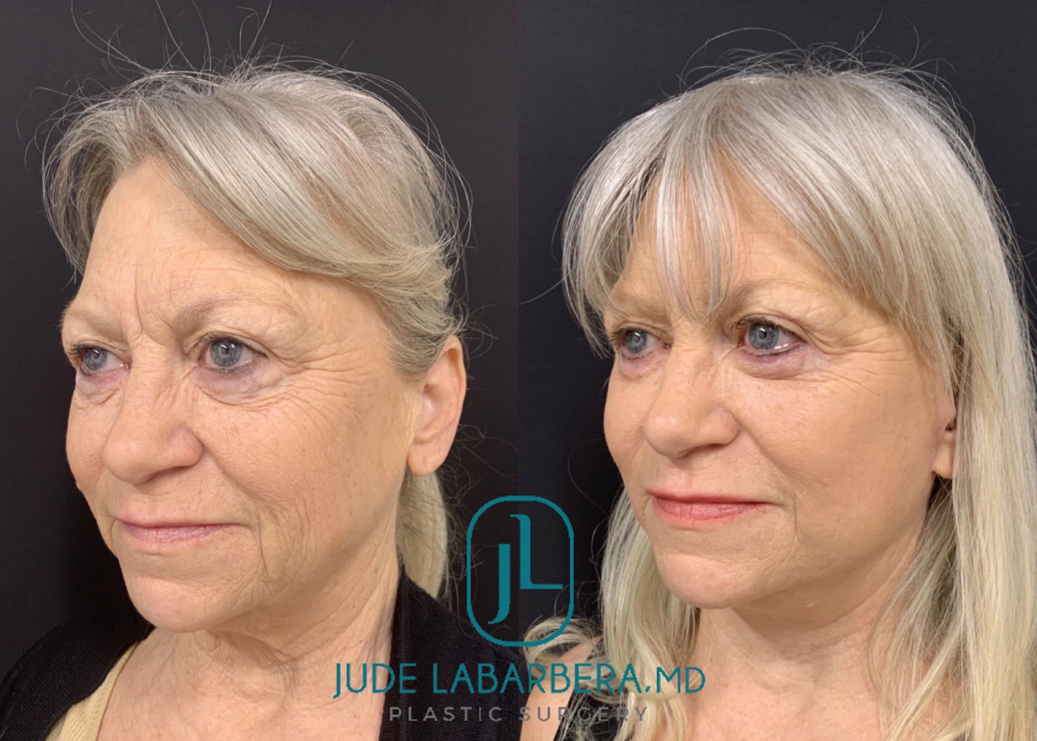 FACELIFT Before & After Case Number 0007