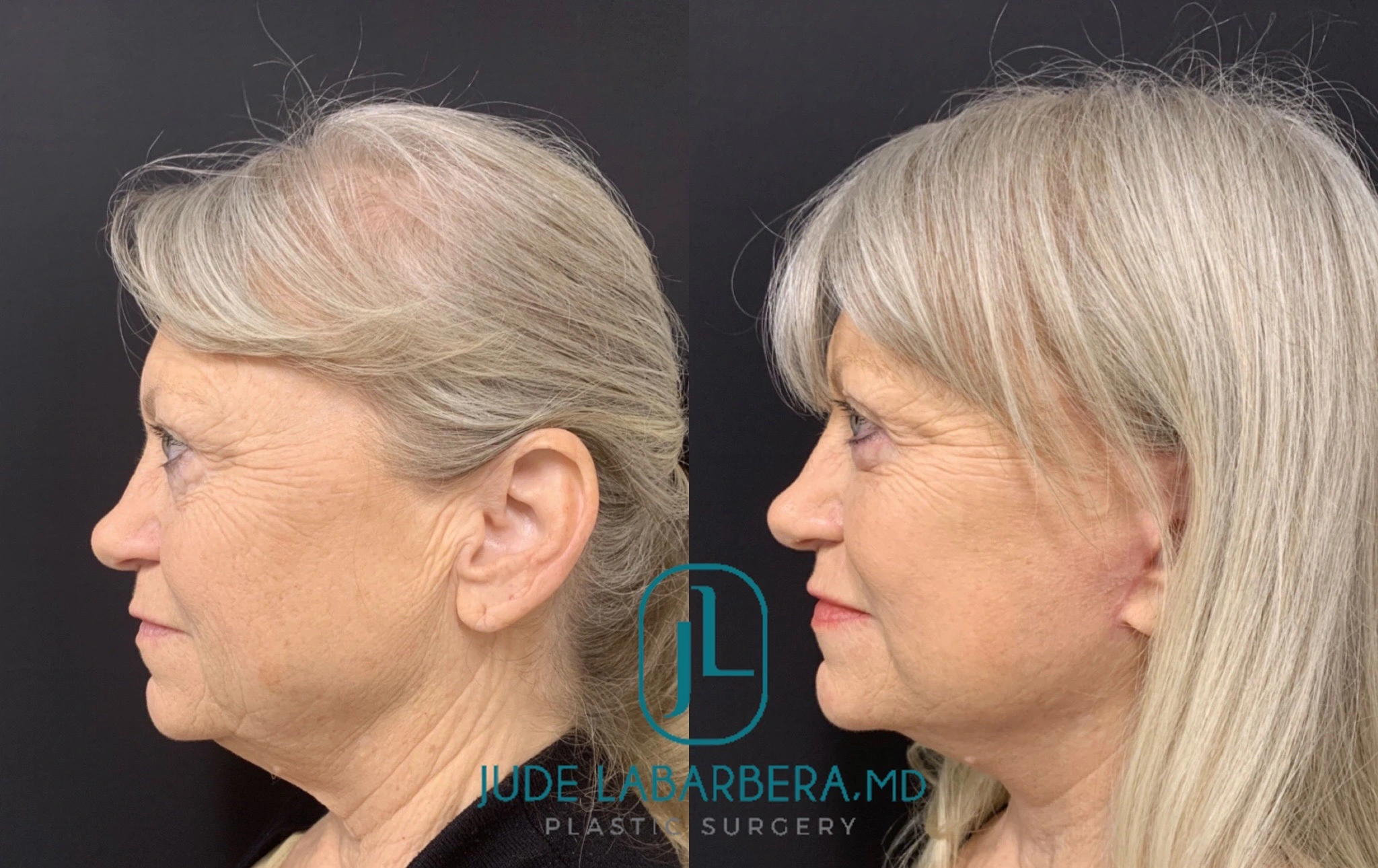 FACELIFT Before & After Case Number 0007
