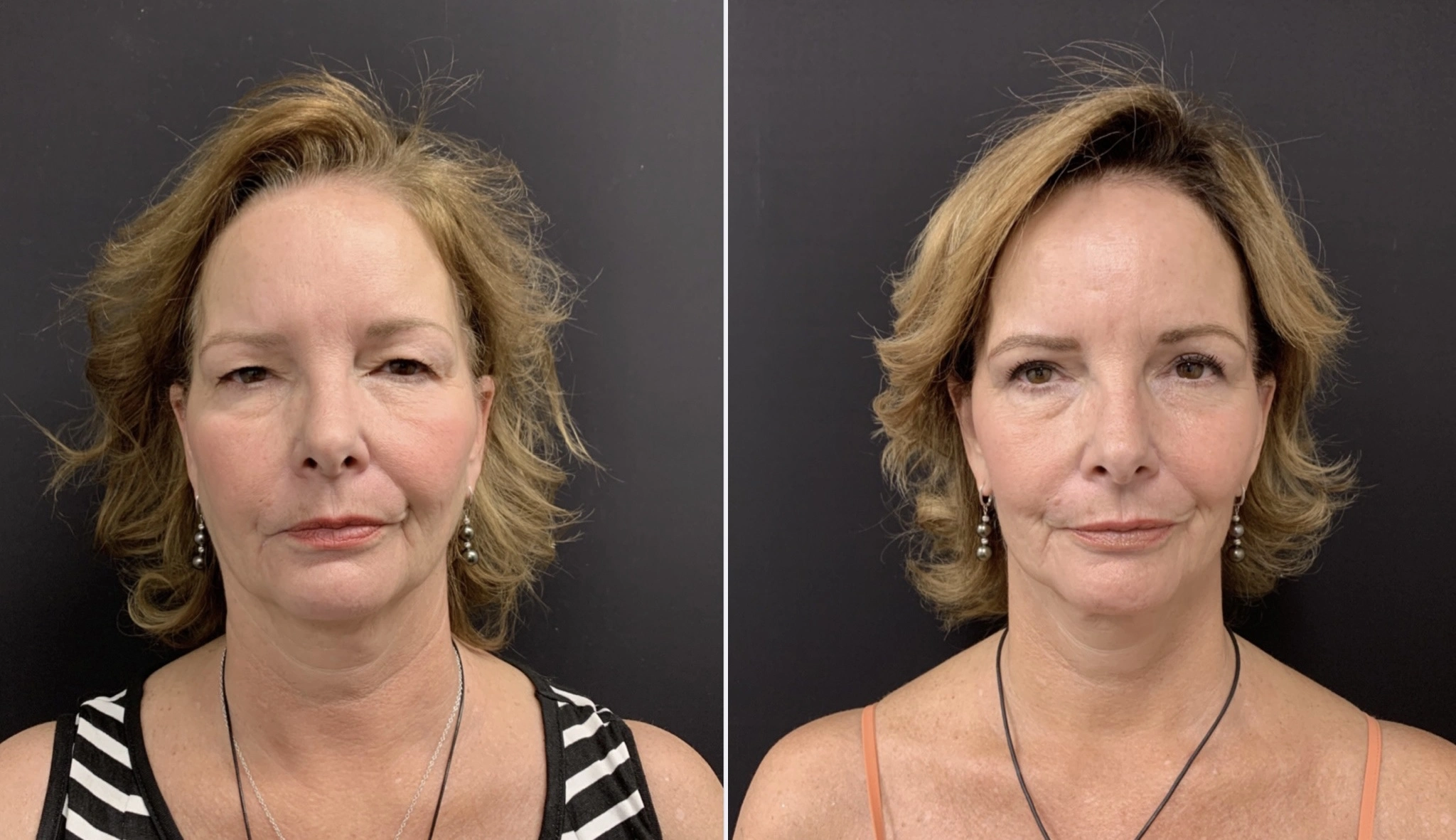 FACELIFT Before & After Case Number 0008