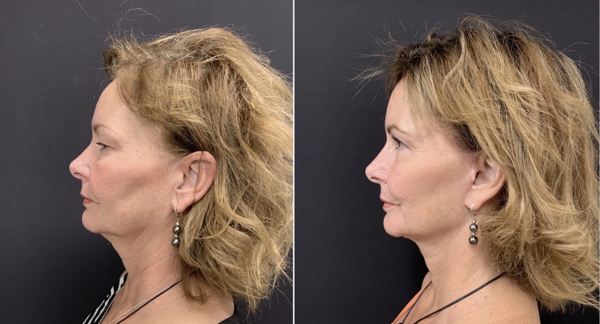 FACELIFT Before & After Case Number 0008