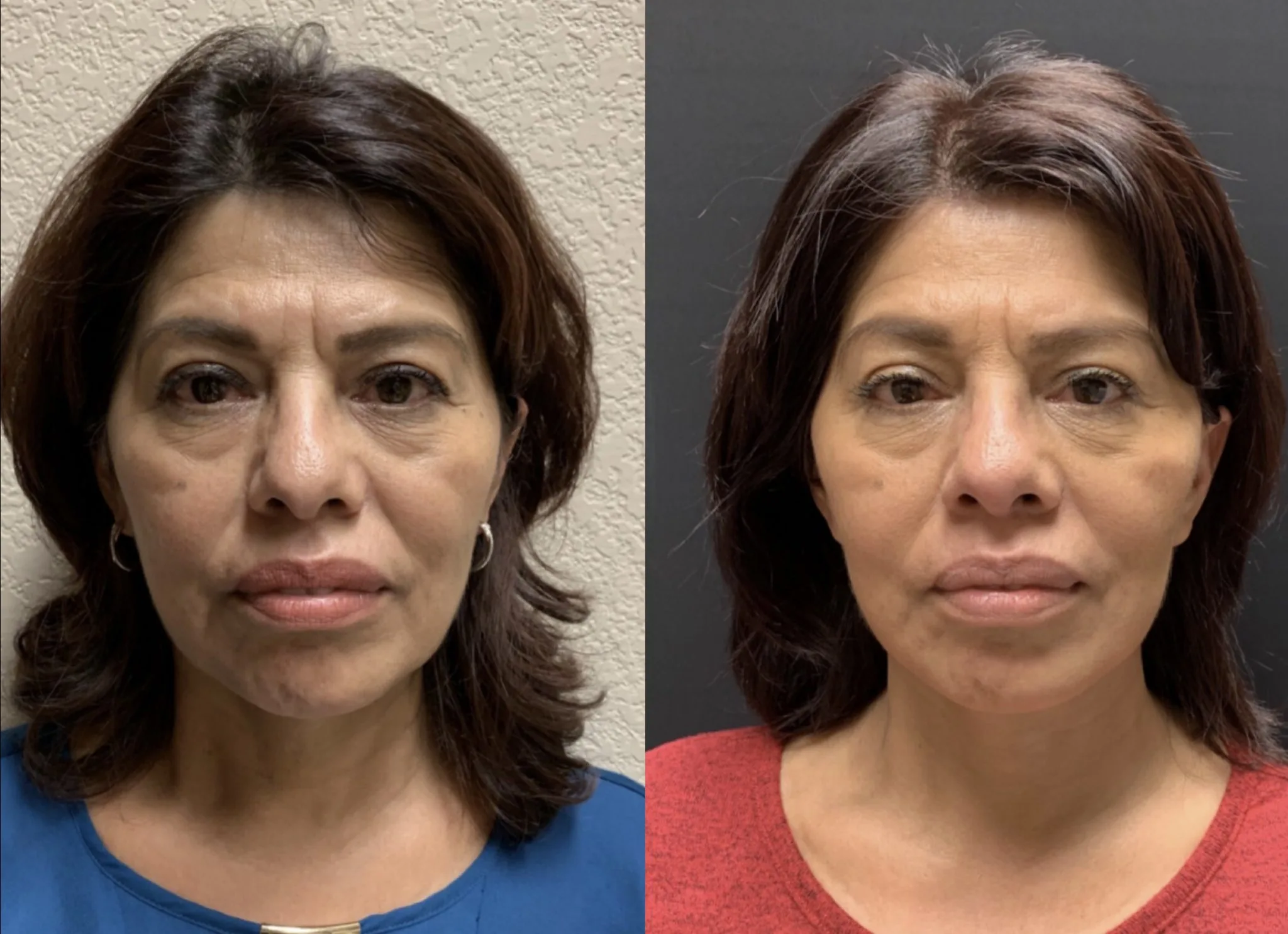FACELIFT & NeckLift Before & After Case Number 0007