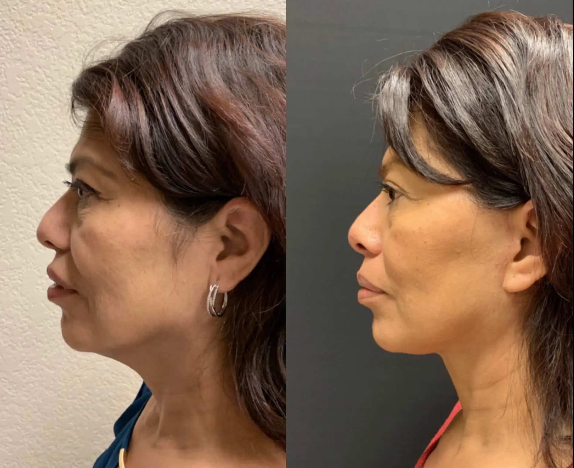 FACELIFT & NeckLift Before & After Case Number 0007