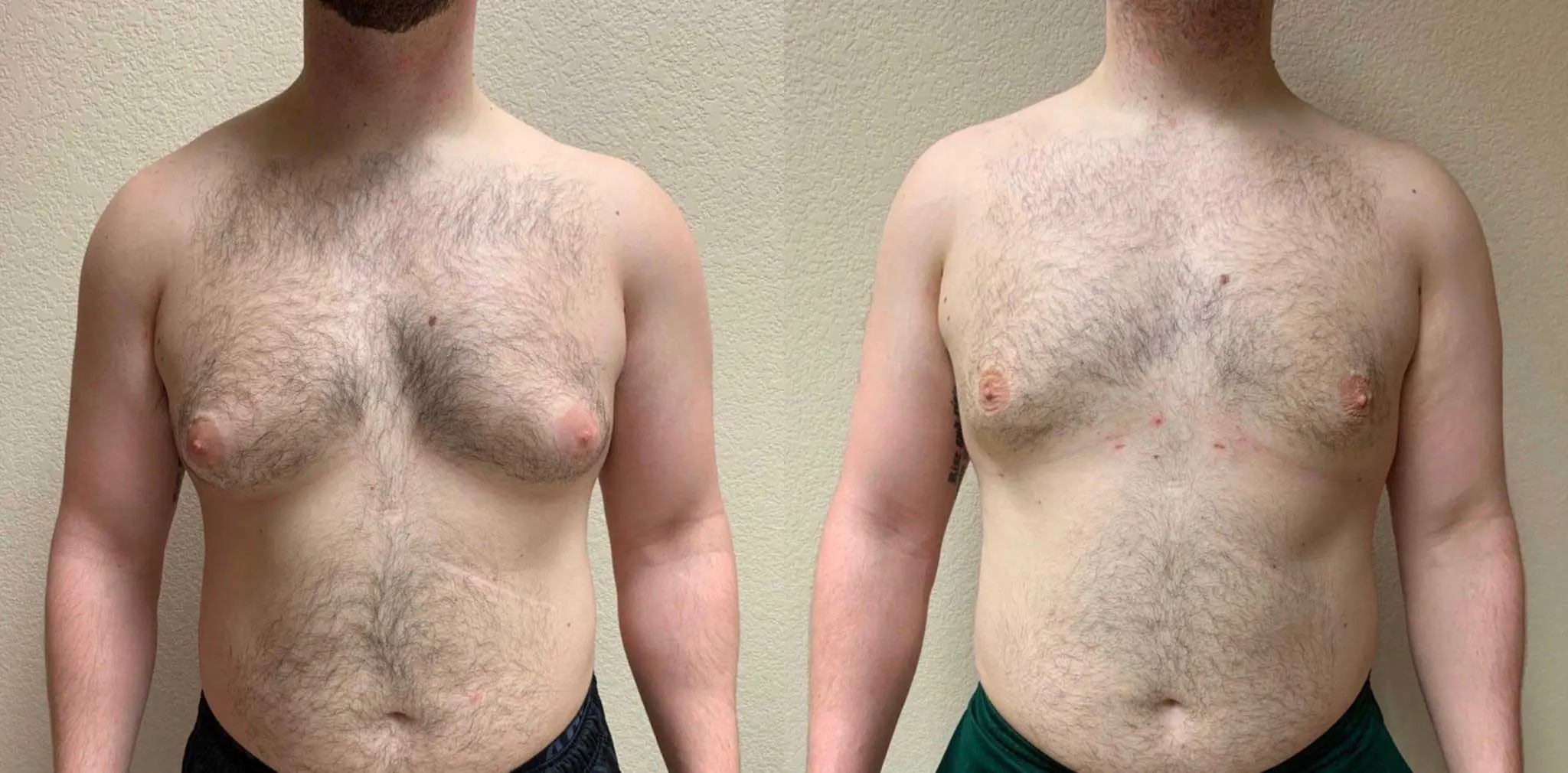GYNECOMASTIA Before & After Case Number 0001