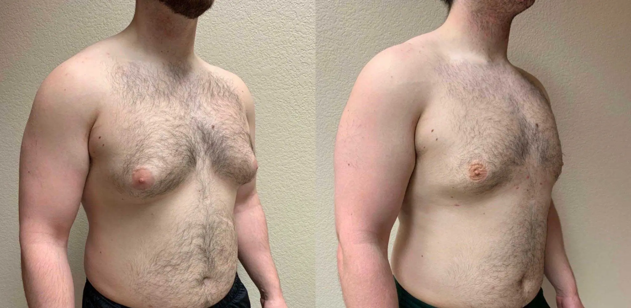 GYNECOMASTIA Before & After Case Number 0001