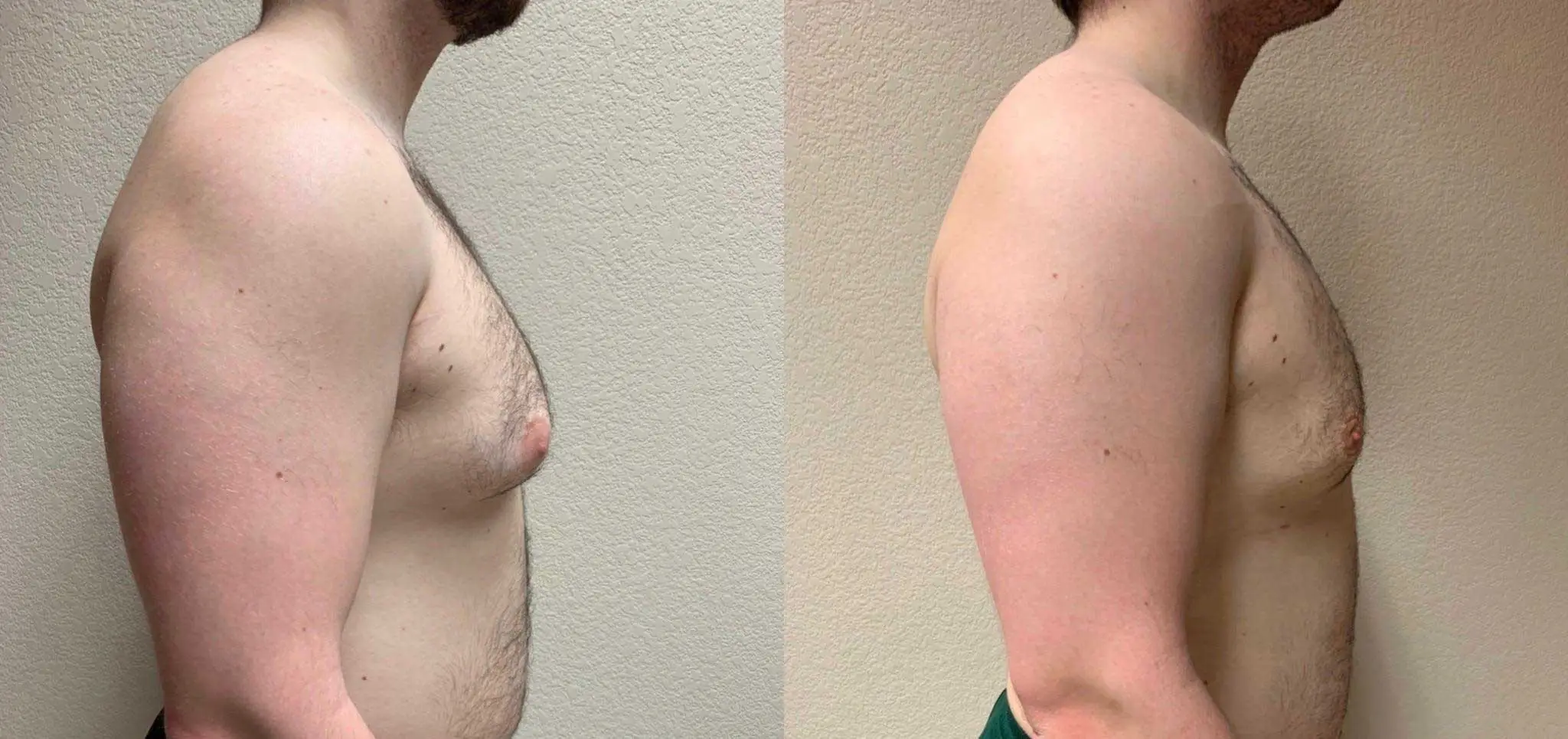 GYNECOMASTIA Before & After Case Number 0001