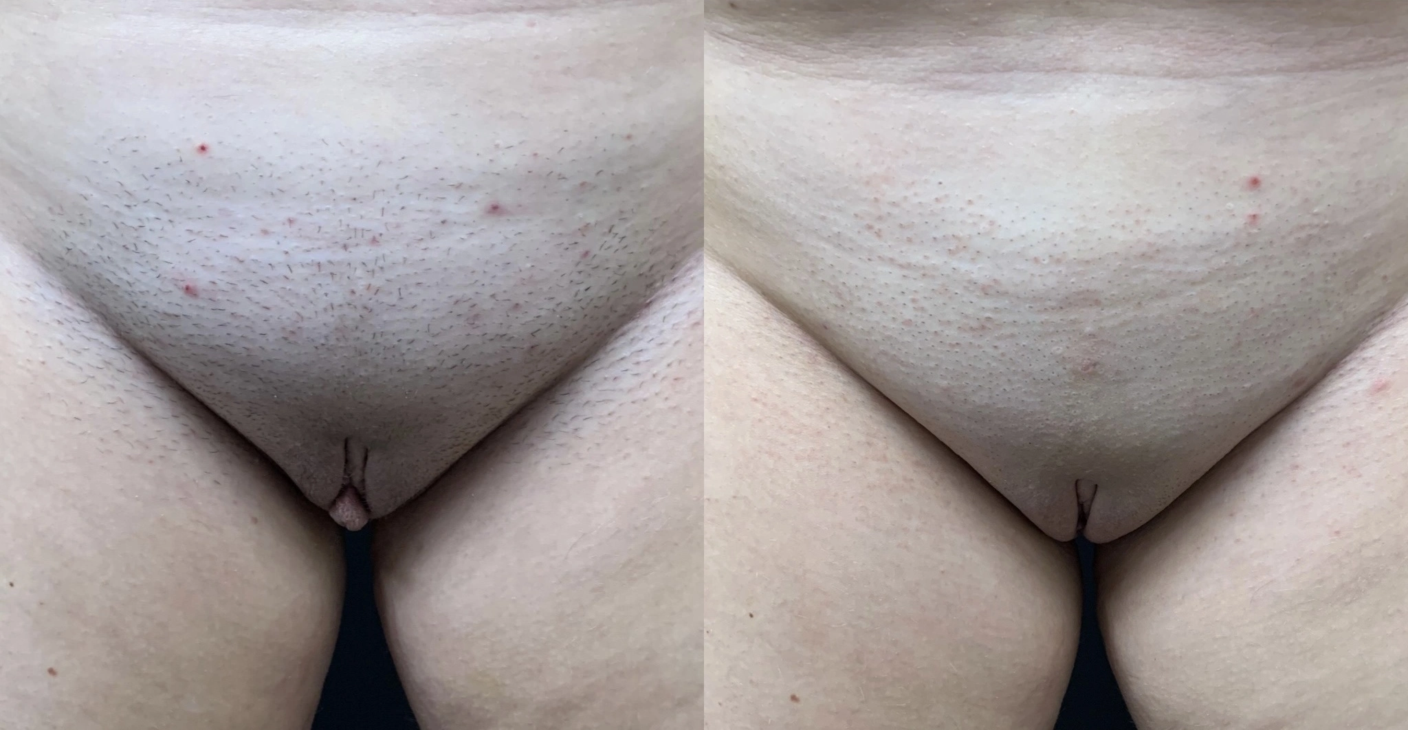 LABIAPLASTY Before & After Case Number 0002