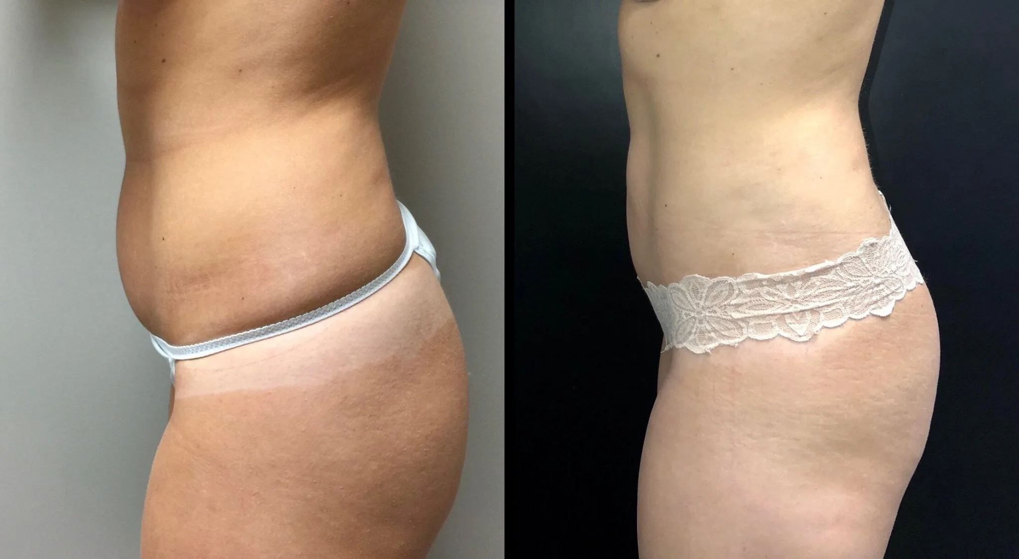 LIPOSUCTION Before & After Case Number 0002