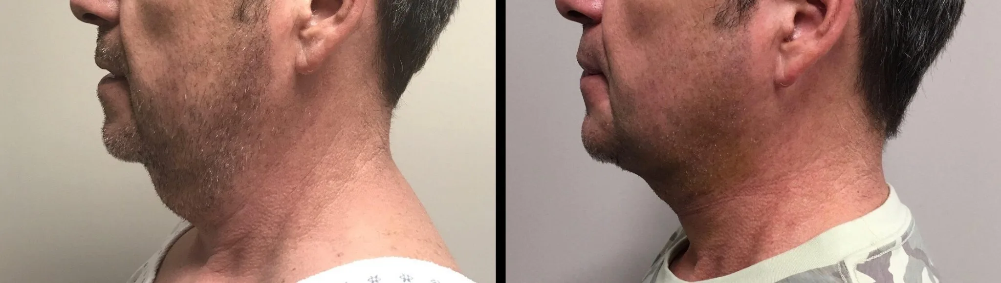 LIPOSUCTION Before & After Case Number 0003