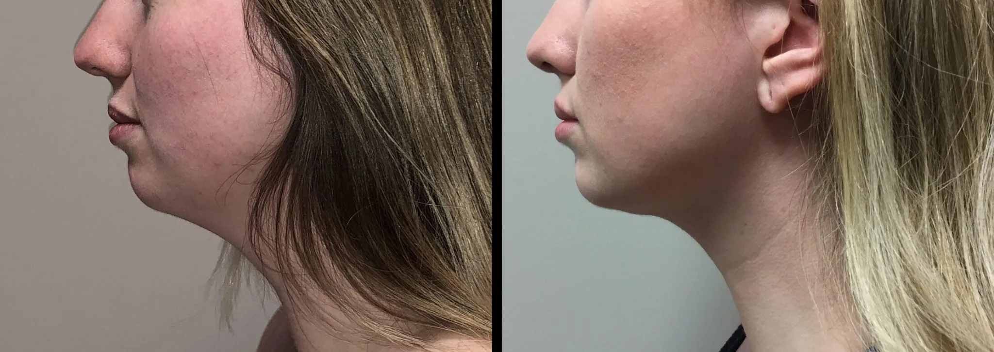 LIPOSUCTION Before & After Case Number 0004