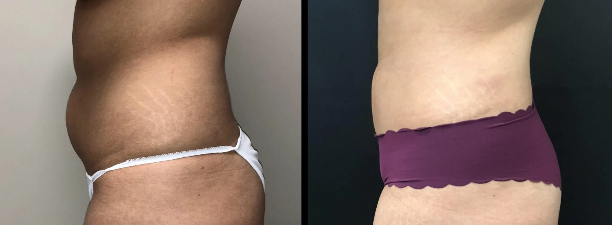 LIPOSUCTION Before & After Case Number 0005