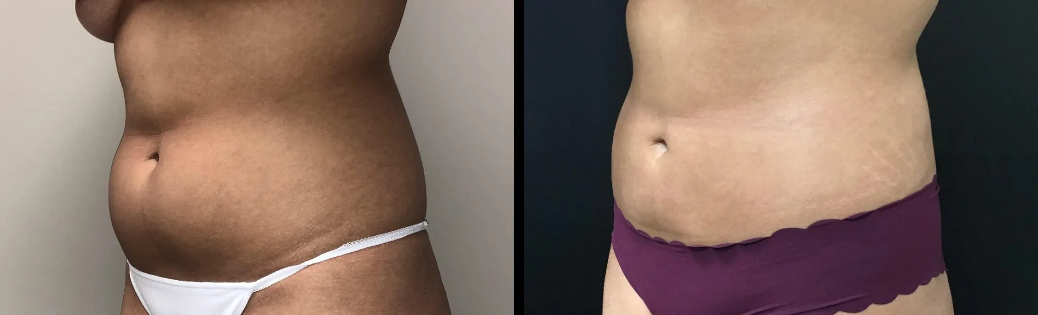 LIPOSUCTION Before & After Case Number 0005
