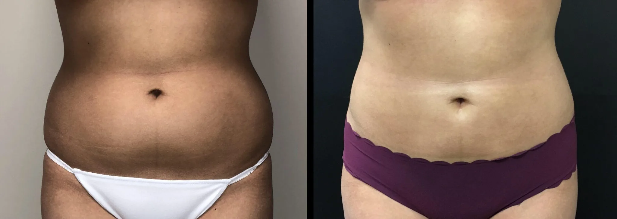 LIPOSUCTION Before & After Case Number 0005