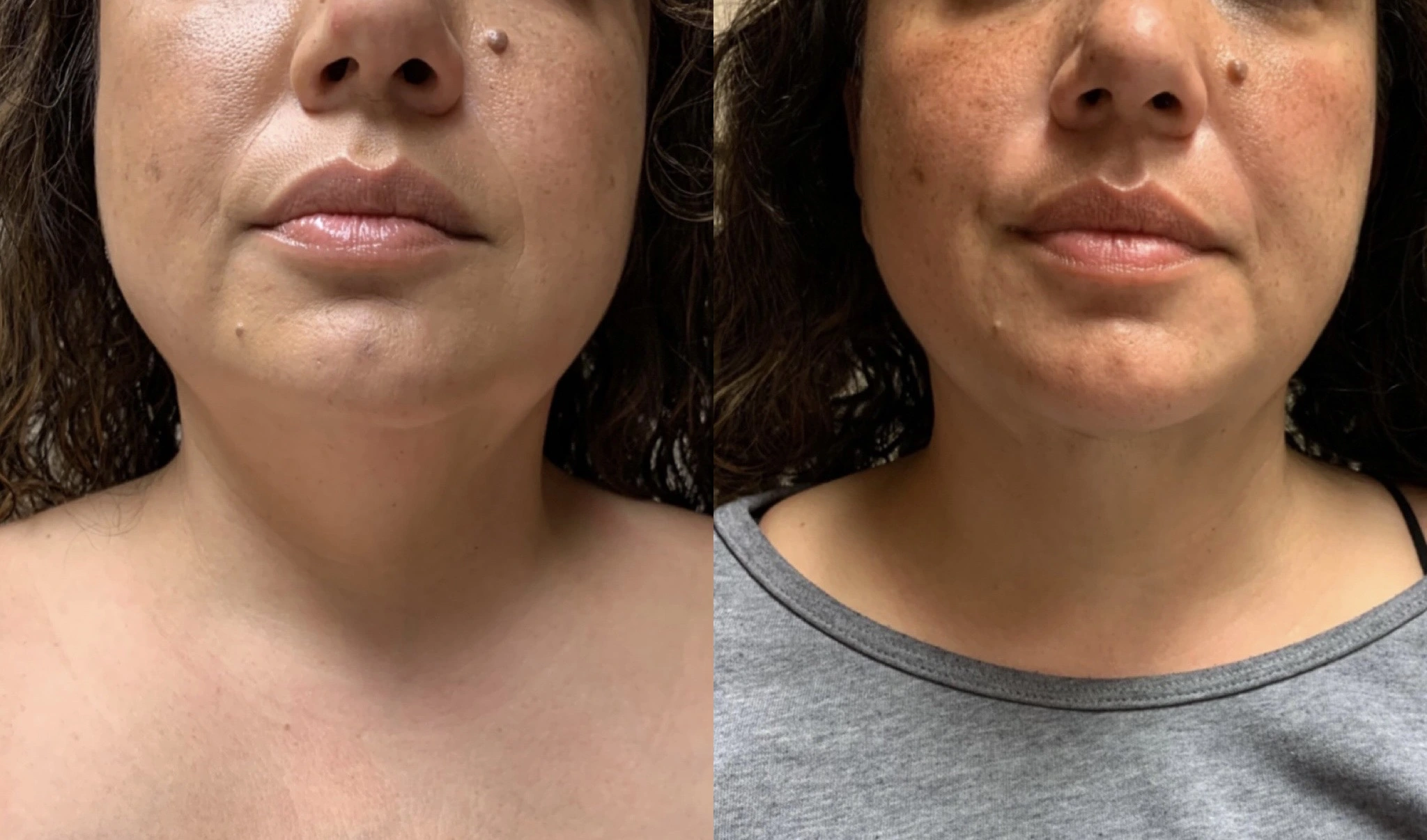 LIPOSUCTION Before & After Case Number 0007