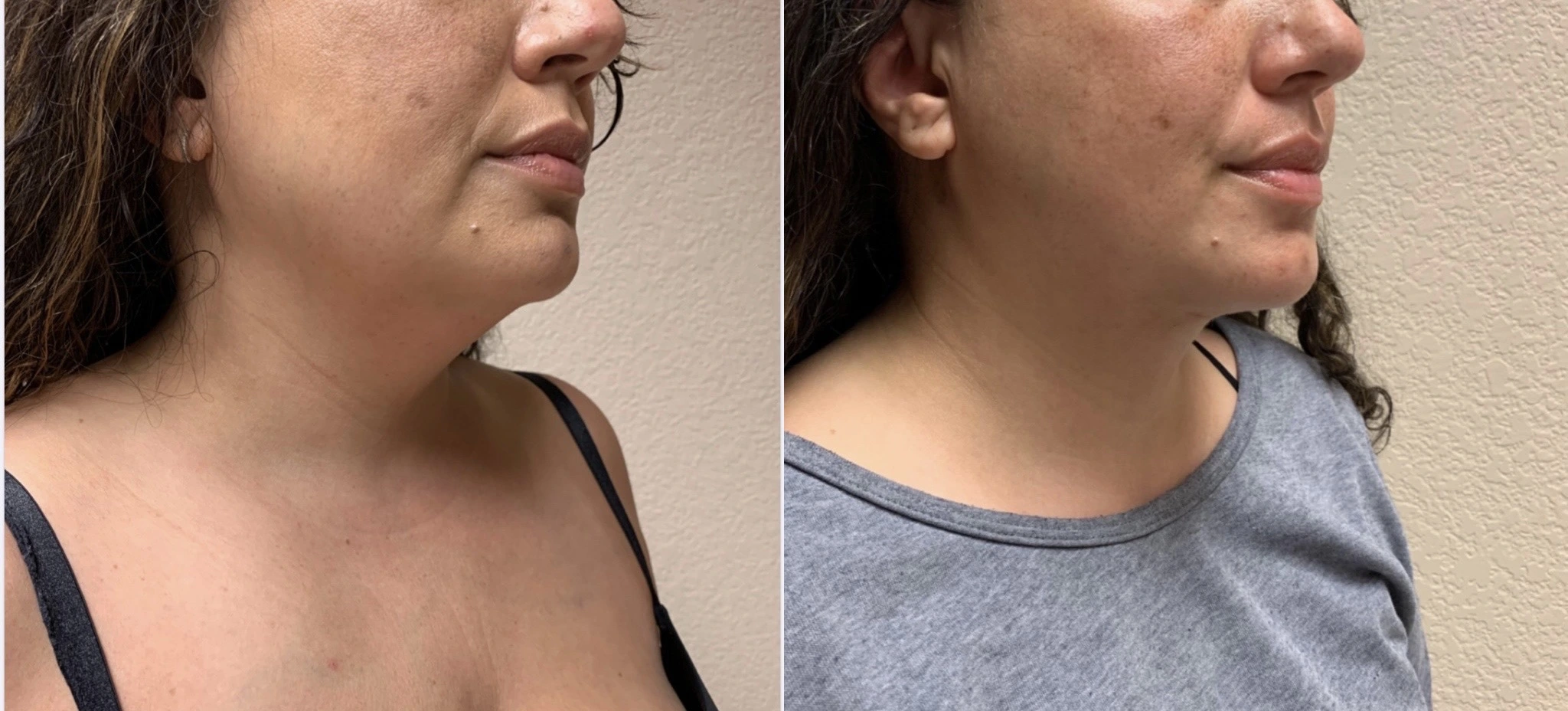 LIPOSUCTION Before & After Case Number 0007