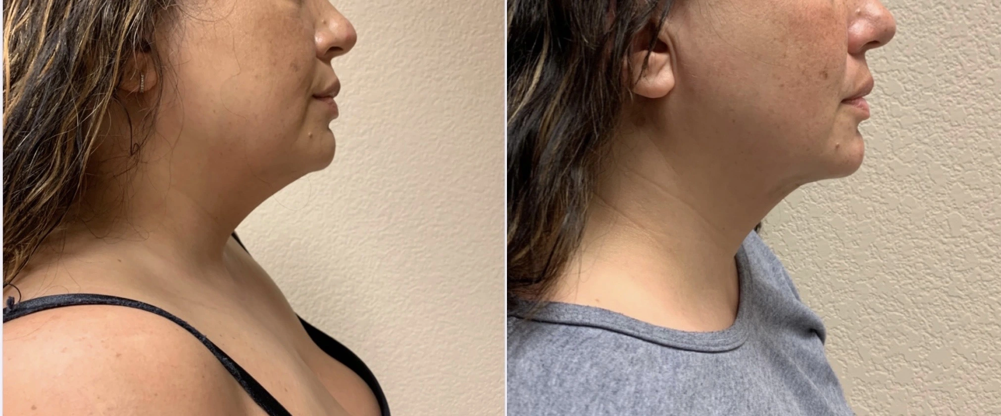LIPOSUCTION Before & After Case Number 0007