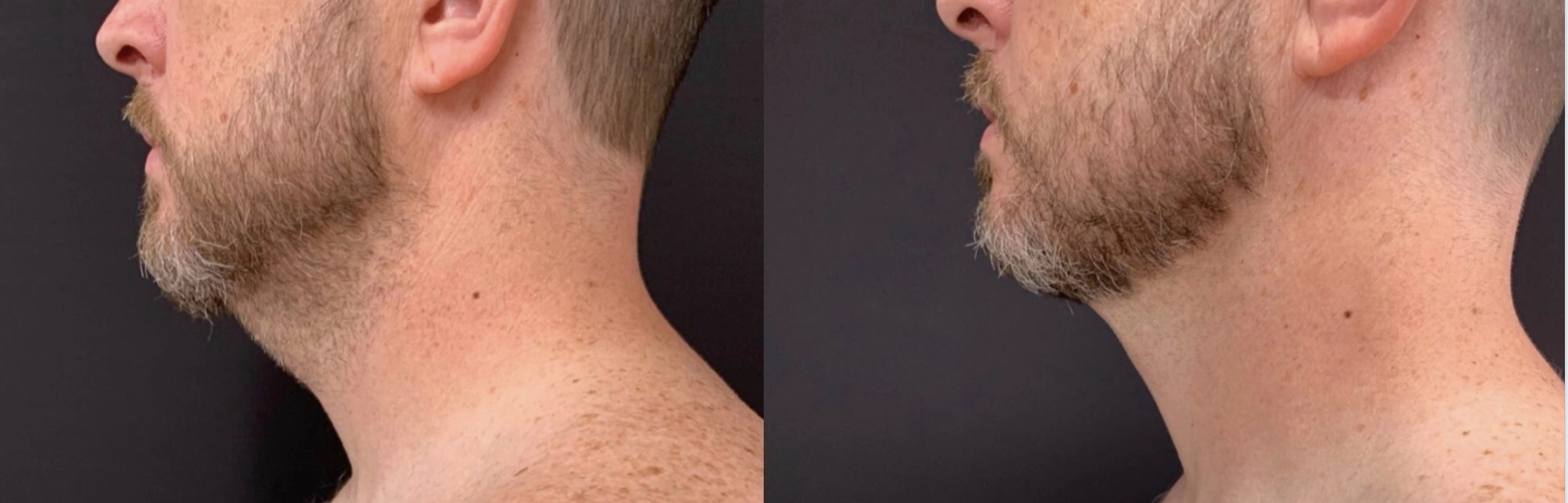 LIPOSUCTION OF SUBMENTAL OR DOUBLE CHIN AREA Before & After Case Number 0008