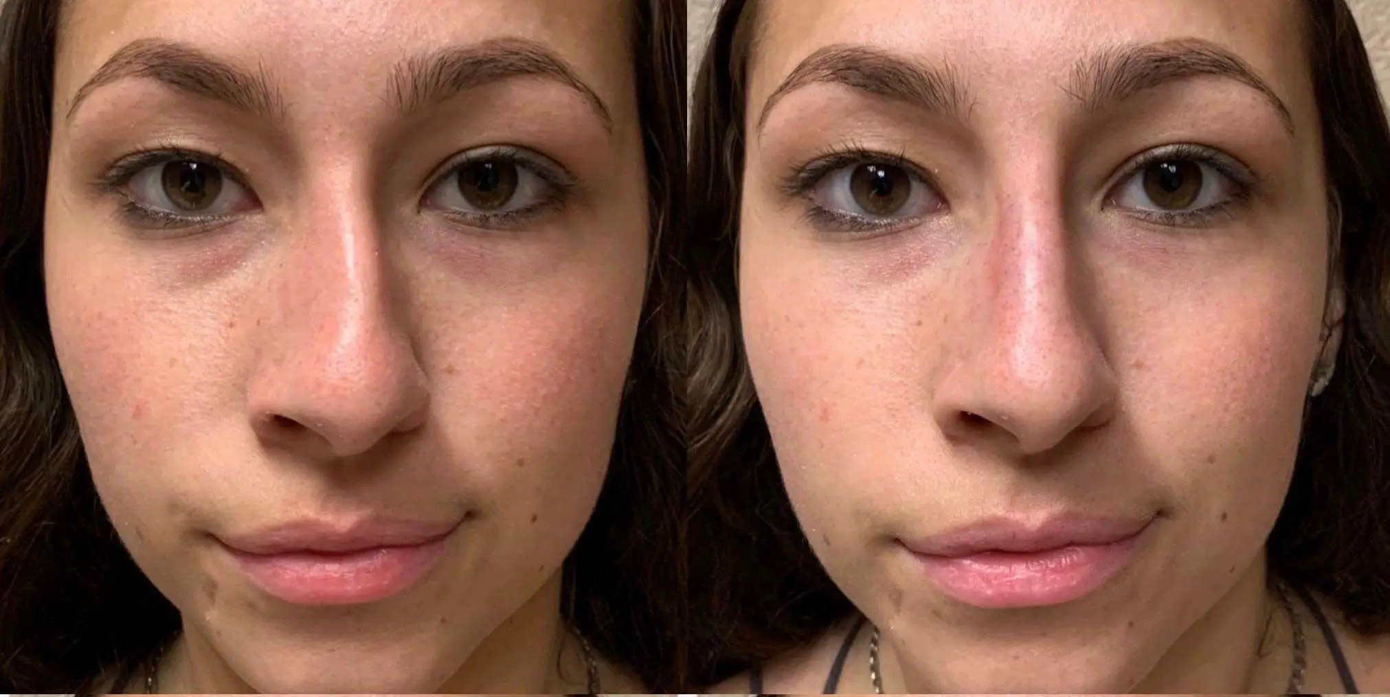 Liquid RHINOPLASTY Before & After Case Number 0001