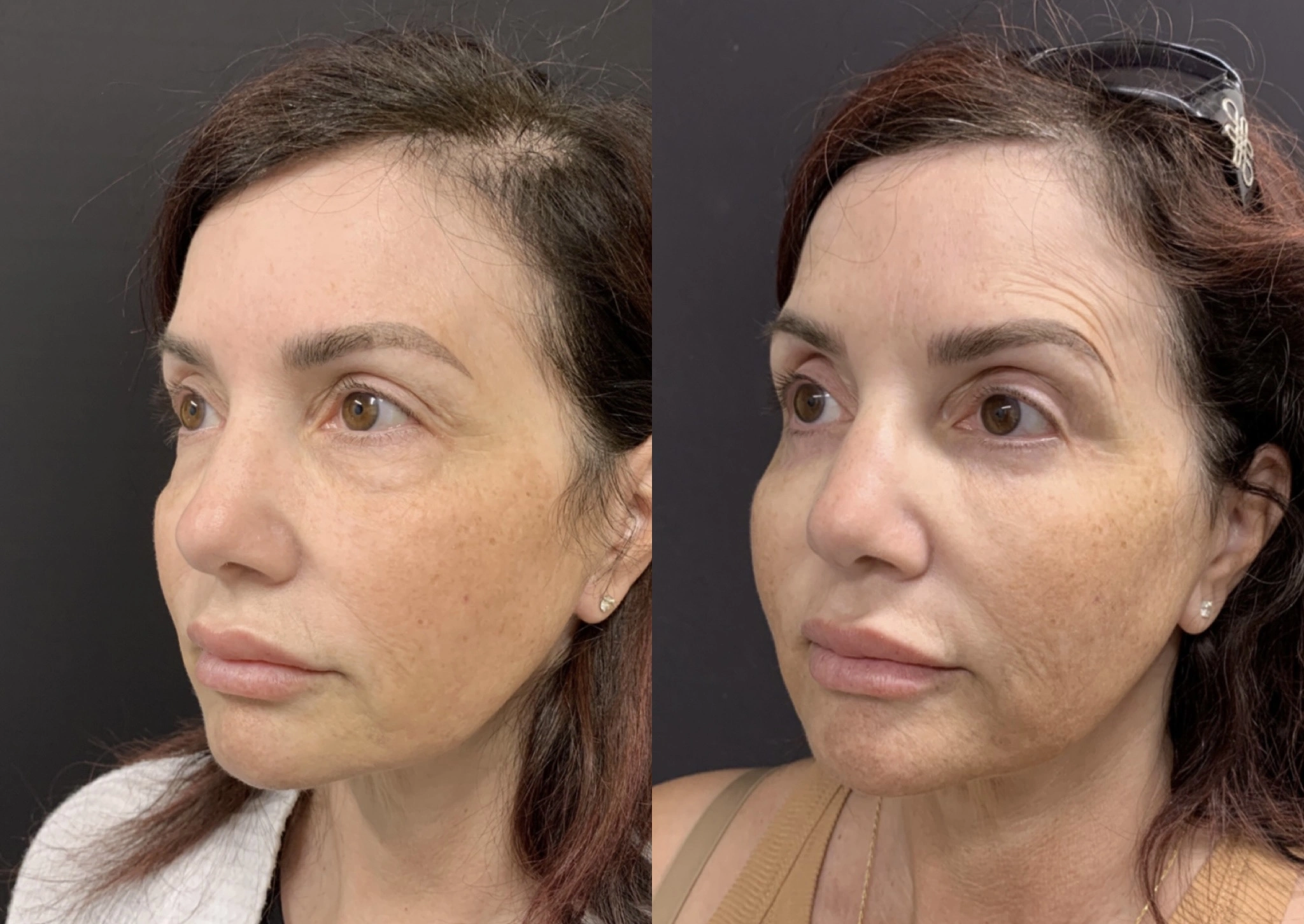 LOWER BLEPHAROPLASTY – LOWER EYELID SURGERY Before & After Case Number 00014