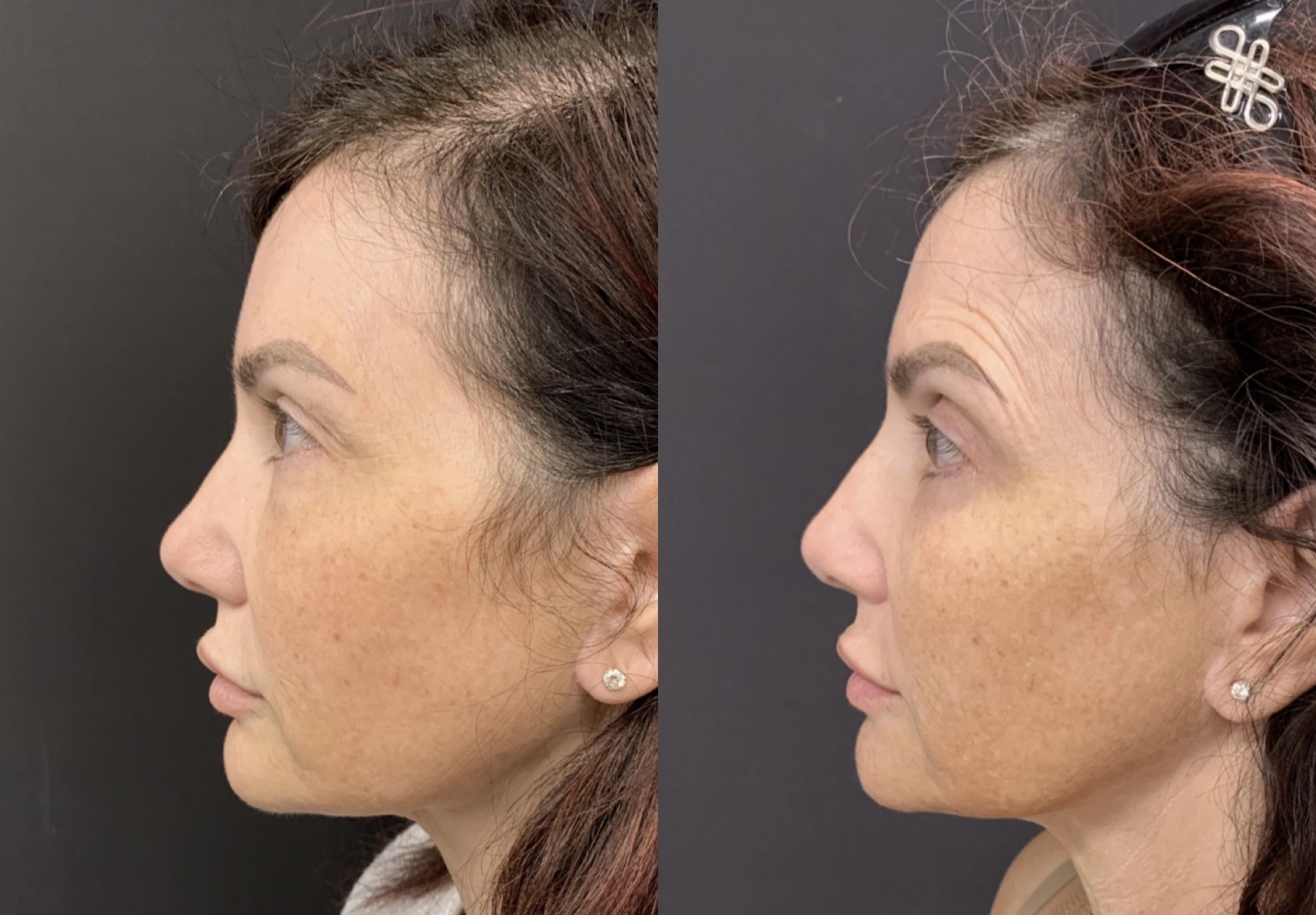LOWER BLEPHAROPLASTY – LOWER EYELID SURGERY Before & After Case Number 00014