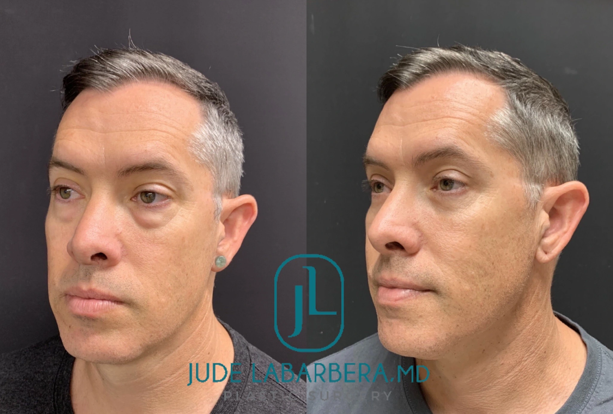 Lower EYELID Lift Before & After Case Number 00016